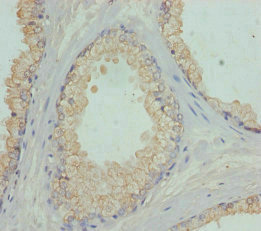 FBXO7 Antibody - Immunohistochemistry of paraffin-embedded human prostate cancer at dilution of 1:100