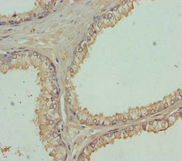 FBXO7 Antibody - Immunohistochemistry of paraffin-embedded human prostate cancer at dilution of 1:100