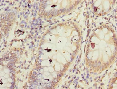 FBXW10 Antibody - Immunohistochemistry of paraffin-embedded human colon cancer using antibody at dilution of 1:100.