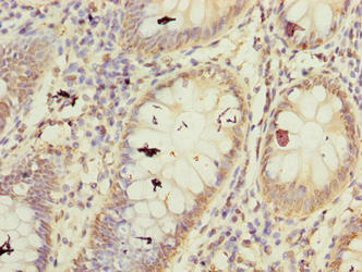FBXW10 Antibody - Immunohistochemistry of paraffin-embedded human colon cancer using FBXW10 Antibody at dilution of 1:100