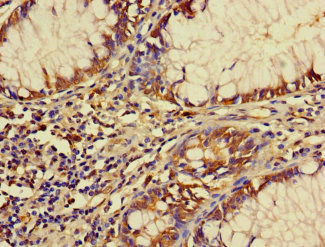 FBXW12 Antibody - Immunohistochemistry of paraffin-embedded human colon cancer using FBXW12 Antibody at dilution of 1:100