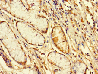 FBXW12 Antibody - Immunohistochemistry of paraffin-embedded human gastric cancer using FBXW12 Antibody at dilution of 1:100