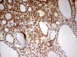FBXW7 / FBW7 Antibody - IHC of paraffin-embedded Carcinoma of Human thyroid tissue using anti-FBXW7 mouse monoclonal antibody. (Heat-induced epitope retrieval by 10mM citric buffer, pH6.0, 120°C for 3min).