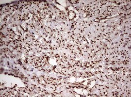 FBXW7 / FBW7 Antibody - IHC of paraffin-embedded Adenocarcinoma of Human endometrium tissue using anti-FBXW7 mouse monoclonal antibody. (Heat-induced epitope retrieval by 10mM citric buffer, pH6.0, 120°C for 3min).