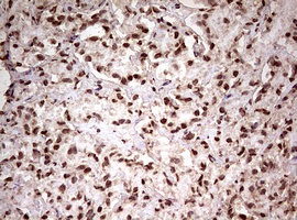 FBXW7 / FBW7 Antibody - IHC of paraffin-embedded Carcinoma of Human prostate tissue using anti-FBXW7 mouse monoclonal antibody. (Heat-induced epitope retrieval by 10mM citric buffer, pH6.0, 120°C for 3min).