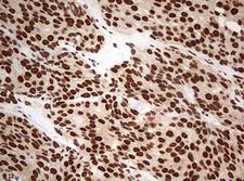 FBXW7 / FBW7 Antibody - IHC of paraffin-embedded Adenocarcinoma of Human breast tissue using anti-FBXW7 mouse monoclonal antibody. (Heat-induced epitope retrieval by 10mM citric buffer, pH6.0, 120°C for 3min).