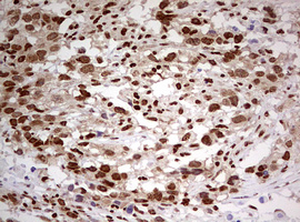 FBXW7 / FBW7 Antibody - IHC of paraffin-embedded Adenocarcinoma of Human ovary tissue using anti-FBXW7 mouse monoclonal antibody. (Heat-induced epitope retrieval by 10mM citric buffer, pH6.0, 120°C for 3min).