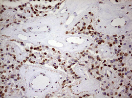 FBXW7 / FBW7 Antibody - IHC of paraffin-embedded Carcinoma of Human pancreas tissue using anti-FBXW7 mouse monoclonal antibody. (Heat-induced epitope retrieval by 10mM citric buffer, pH6.0, 120°C for 3min).