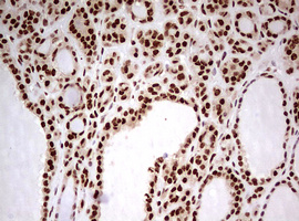 FBXW7 / FBW7 Antibody - IHC of paraffin-embedded Carcinoma of Human thyroid tissue using anti-FBXW7 mouse monoclonal antibody. (Heat-induced epitope retrieval by 10mM citric buffer, pH6.0, 120°C for 3min).