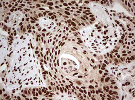 FBXW7 / FBW7 Antibody - IHC of paraffin-embedded Carcinoma of Human lung tissue using anti-FBXW7 mouse monoclonal antibody. (Heat-induced epitope retrieval by 10mM citric buffer, pH6.0, 120°C for 3min).