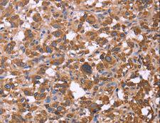 FBXW7 / FBW7 Antibody - Immunohistochemistry of paraffin-embedded Human liver cancer using FBXW7 Polyclonal Antibody at dilution of 1:30.