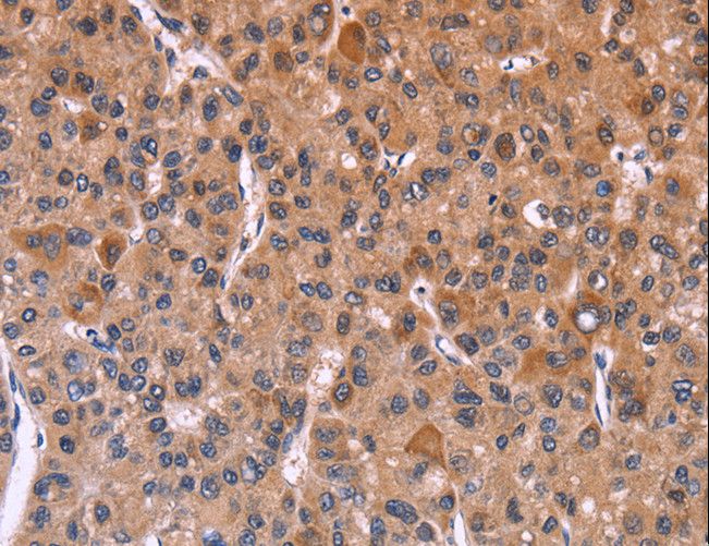 FBXW7 / FBW7 Antibody - Immunohistochemistry of paraffin-embedded Human liver cancer using FBXW7 Polyclonal Antibody at dilution of 1:30.