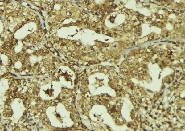 FBXW7 / FBW7 Antibody - 1:100 staining human breast carcinoma tissue by IHC-P. The sample was formaldehyde fixed and a heat mediated antigen retrieval step in citrate buffer was performed. The sample was then blocked and incubated with the antibody for 1.5 hours at 22°C. An HRP conjugated goat anti-rabbit antibody was used as the secondary.