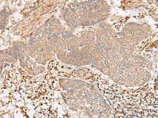 FBXW8 Antibody - Immunohistochemistry of paraffin-embedded Human esophagus cancer tissue  using FBXW8 Polyclonal Antibody at dilution of 1:65(×200)