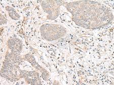 FBXW8 Antibody - Immunohistochemistry of paraffin-embedded Human esophagus cancer tissue  using FBXW8 Polyclonal Antibody at dilution of 1:70(×200)