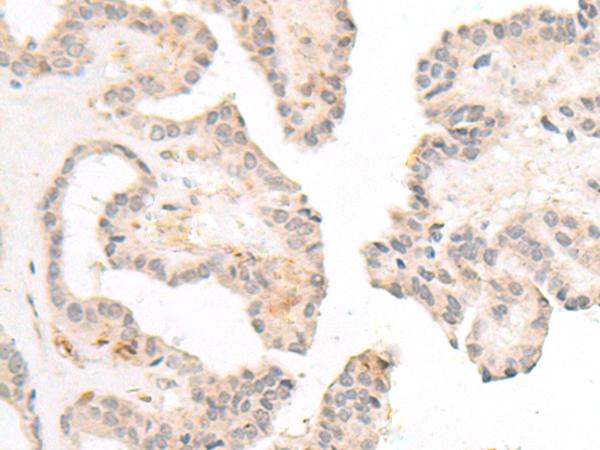 FBXW8 Antibody - Immunohistochemistry of paraffin-embedded Human thyroid cancer tissue  using FBXW8 Polyclonal Antibody at dilution of 1:70(×200)
