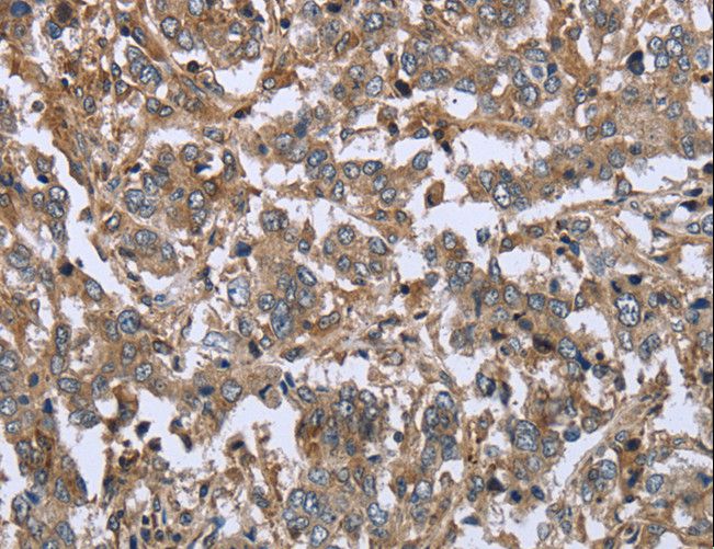 FCAR / CD89 Antibody - Immunohistochemistry of paraffin-embedded Human liver cancer using FCAR Polyclonal Antibody at dilution of 1:20.