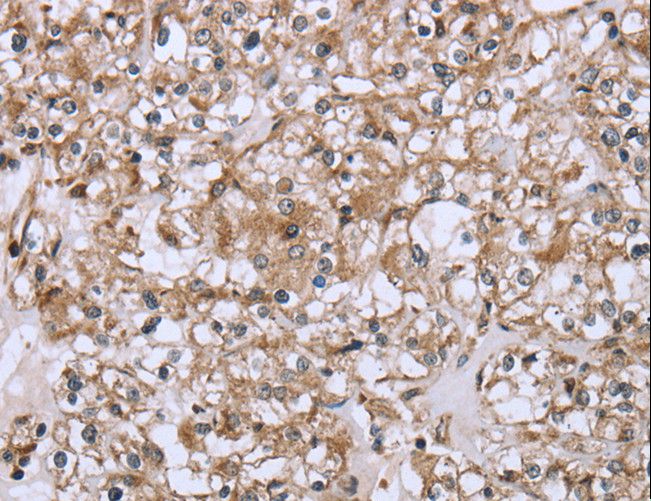 FCAR / CD89 Antibody - Immunohistochemistry of paraffin-embedded Human prostate cancer using FCAR Polyclonal Antibody at dilution of 1:20.