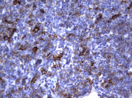 FCER2 / CD23 Antibody - IHC of paraffin-embedded Human lymphoma tissue using anti-FCER2 mouse monoclonal antibody.