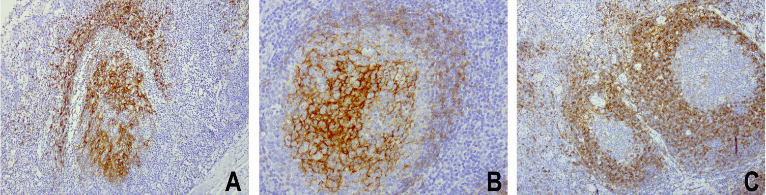 FCER2 / CD23 Antibody - Immunohistochemical staining of paraffin-embedded human tonsil using FCER2. (CD23) clone UMAB101, mouse monoclonal antibody at 1:400 dilution of 1mg/mL using Polink2 Broad HRP DAB for detection.requires heat-induced epitope retrieval with citrate pH6.0 at 110C for 3 min using pressure chamber/cooker. The image is a composite of 3 tonsils which show strong membranous and cytoplasmic staining however each tonsil has a unique expression pattern in the inner and outer germinal center.