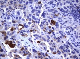 FCER2 / CD23 Antibody - IHC of paraffin-embedded Carcinoma of Human bladder tissue using anti-FCER2 mouse monoclonal antibody.