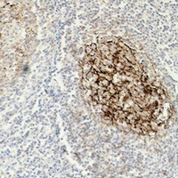 FCER2 / CD23 Antibody - Immunohistochemical analysis of CD23 staining in human tonsil cancer formalin fixed paraffin embedded tissue section. The section was pre-treated using heat mediated antigen retrieval with sodium citrate buffer (pH 6.0). The section was then incubated with the antibody at room temperature and detected using an HRP conjugated compact polymer system. DAB was used as the chromogen. The section was then counterstained with hematoxylin and mounted with DPX.