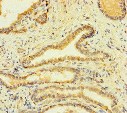 FcERI / Fc Epsilon RI Antibody - Immunohistochemistry of paraffin-embedded human prostate cancer at dilution of 1:100
