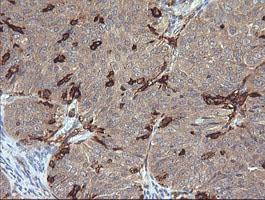 FCGR1A / CD64 Antibody - IHC of paraffin-embedded Adenocarcinoma of Human ovary tissue using anti-FCGR1A mouse monoclonal antibody.
