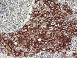 FCGR1A / CD64 Antibody - IHC of paraffin-embedded Human lymphoma tissue using anti-FCGR1A mouse monoclonal antibody.