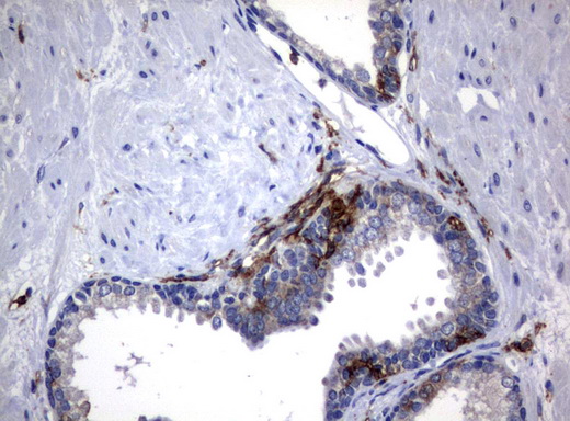 FCGR1A / CD64 Antibody - Immunohistochemical staining of paraffin-embedded Human prostate tissue using anti-FCGR1A mouse monoclonal antibody.  heat-induced epitope retrieval by 10mM citric buffer, pH6.0, 120C for 3min)