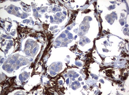 FCGR1A / CD64 Antibody - Immunohistochemical staining of paraffin-embedded Carcinoma of Human bladder tissue using anti-FCGR1A mouse monoclonal antibody.  heat-induced epitope retrieval by 10mM citric buffer, pH6.0, 120C for 3min)
