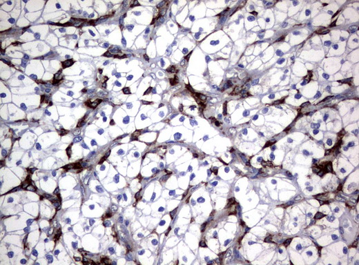 FCGR1A / CD64 Antibody - Immunohistochemical staining of paraffin-embedded Carcinoma of Human kidney tissue using anti-FCGR1A mouse monoclonal antibody.  heat-induced epitope retrieval by 10mM citric buffer, pH6.0, 120C for 3min)