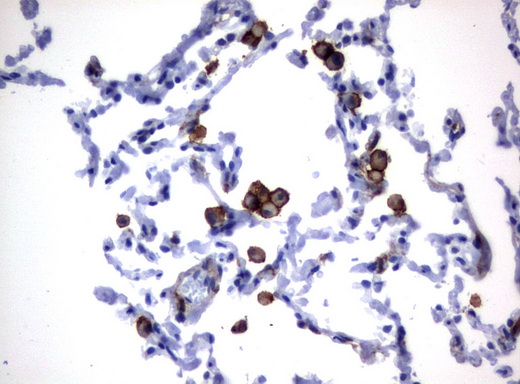 FCGR1A / CD64 Antibody - Immunohistochemical staining of paraffin-embedded Human lung tissue using anti-FCGR1A mouse monoclonal antibody.  heat-induced epitope retrieval by 10mM citric buffer, pH6.0, 120C for 3min)