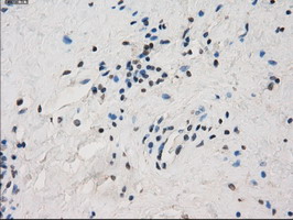 FCGR2 / CD32 Antibody - IHC of paraffin-embedded Carcinoma of thyroid tissue using anti-FCGR2A mouse monoclonal antibody. (Dilution 1:50).