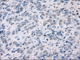 FCGR2 / CD32 Antibody - IHC of paraffin-embedded Carcinoma of bladder tissue using anti-FCGR2A mouse monoclonal antibody. (Dilution 1:50).