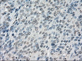 FCGR2 / CD32 Antibody - IHC of paraffin-embedded Carcinoma of bladder tissue using anti-FCGR2A mouse monoclonal antibody. (Dilution 1:50).
