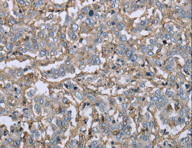 FCGR2 / CD32 Antibody - Immunohistochemistry of paraffin-embedded Human liver cancer using FCGR2B Polyclonal Antibody at dilution of 1:40.