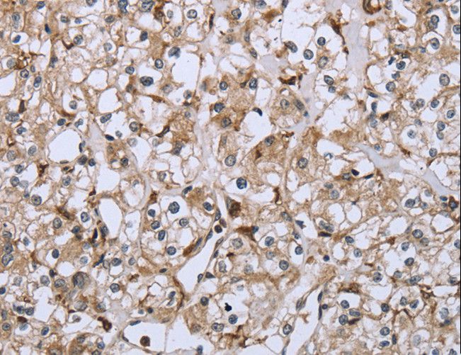 FCGR2 / CD32 Antibody - Immunohistochemistry of paraffin-embedded Human prostate cancer using FCGR2B Polyclonal Antibody at dilution of 1:40.