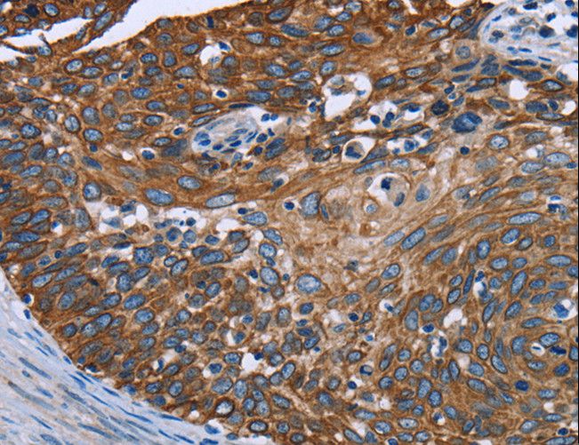 FCGR3A / CD16A Antibody - Immunohistochemistry of paraffin-embedded Human cervical cancer using FCGR3A Polyclonal Antibody at dilution of 1:40.