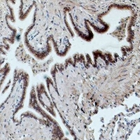 FCGR3A / CD16A Antibody - Immunohistochemical analysis of CD16 staining in human lung cancer formalin fixed paraffin embedded tissue section. The section was pre-treated using heat mediated antigen retrieval with sodium citrate buffer (pH 6.0). The section was then incubated with the antibody at room temperature and detected using an HRP conjugated compact polymer system. DAB was used as the chromogen. The section was then counterstained with hematoxylin and mounted with DPX.