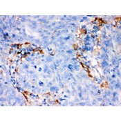 FCGRT / FCRN Antibody - FCGRT was detected in paraffin-embedded sections of human lung cancer tissues using rabbit anti- FCGRT Antigen Affinity purified polyclonal antibody at 1 ug/mL. The immunohistochemical section was developed using SABC method.