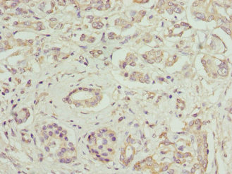 FCGRT / FCRN Antibody - Immunohistochemistry of paraffin-embedded human pancreatic cancer using FCGRT Antibody at dilution of 1:100