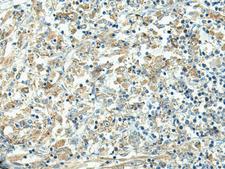 FCGRT / FCRN Antibody - Immunohistochemistry of paraffin-embedded Human liver cancer tissue  using FCGRT Polyclonal Antibody at dilution of 1:45(×200)