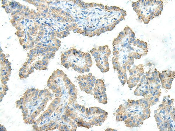 FCGRT / FCRN Antibody - Immunohistochemistry of paraffin-embedded Human thyroid cancer tissue  using FCGRT Polyclonal Antibody at dilution of 1:45(×200)