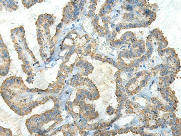 FCGRT / FCRN Antibody - Immunohistochemistry of paraffin-embedded Human thyroid cancer tissue  using FCGRT Polyclonal Antibody at dilution of 1:65(×200)