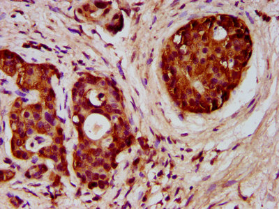FCHO1 Antibody - Immunohistochemistry image at a dilution of 1:300 and staining in paraffin-embedded human pancreatic cancer performed on a Leica BondTM system. After dewaxing and hydration, antigen retrieval was mediated by high pressure in a citrate buffer (pH 6.0) . Section was blocked with 10% normal goat serum 30min at RT. Then primary antibody (1% BSA) was incubated at 4 °C overnight. The primary is detected by a biotinylated secondary antibody and visualized using an HRP conjugated SP system.