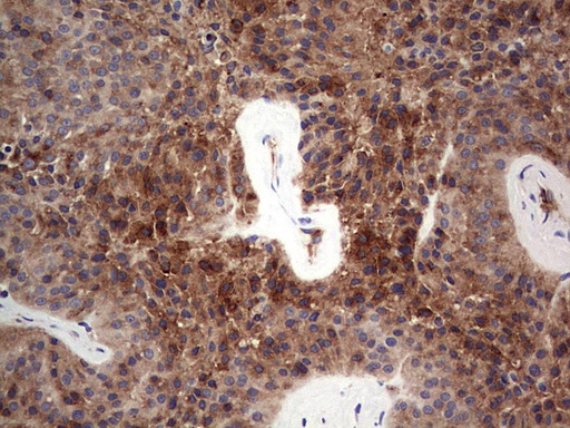 FCMR / FAIM3 Antibody - IHC of paraffin-embedded Carcinoma of Human thyroid tissue using anti-FAIM3 mouse monoclonal antibody. (Heat-induced epitope retrieval by 1 mM EDTA in 10mM Tris, pH8.5, 120°C for 3min).