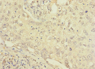 FCRL2 / IRTA4 Antibody - Immunohistochemistry of paraffin-embedded human lung cancer at dilution 1:100