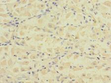 FCRL2 / IRTA4 Antibody - Immunohistochemistry of paraffin-embedded human gastric cancer at dilution 1:100