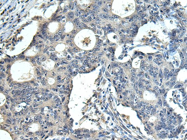 FCRLA Antibody - Immunohistochemistry of paraffin-embedded Human colorectal cancer tissue  using FCRLA Polyclonal Antibody at dilution of 1:90(×200)